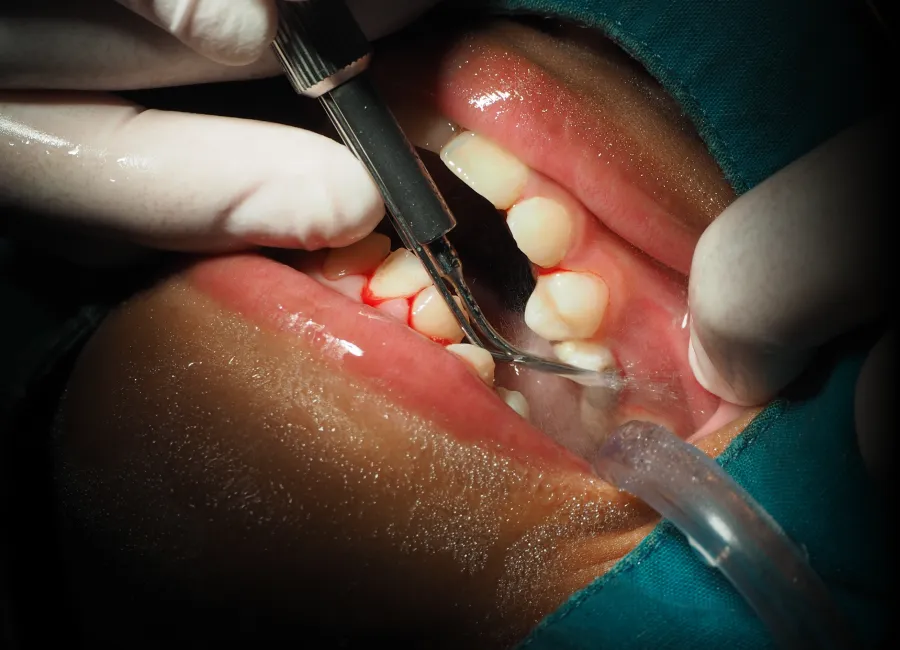 Non Surgical Gum Treatment at [pracitice_name] in Santa Fe, NM