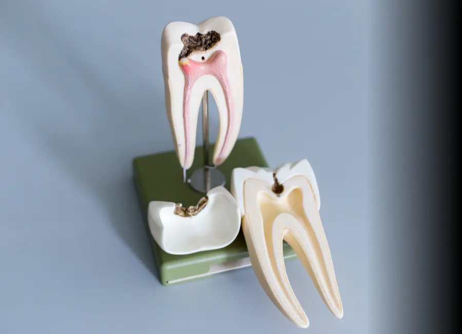 Root Canal Therapy at [pracitice_name] in Santa Fe, NM