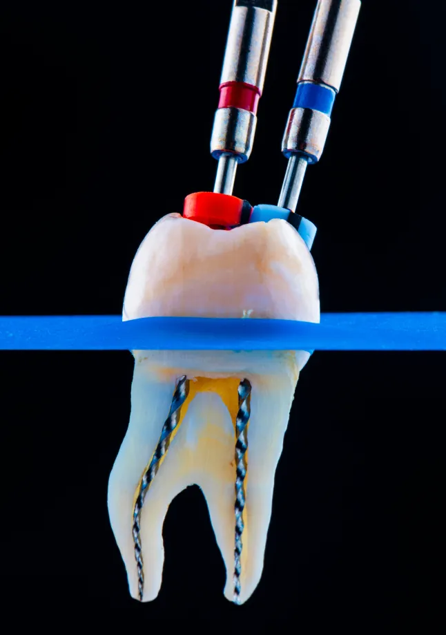 Root Canal Treatment at Divine Dental in Santa Fe, NM